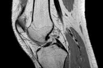 Prevalence of Knee Osteoarthritis Features on Magnetic Resonance Imaging in Asymptomatic Uninjured Adults